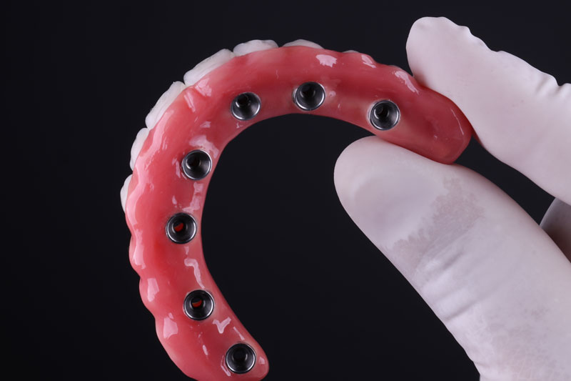Dental Implants Prosthetic Porcelain Rehabilitation, dentist is holding the model in a dark room with black gloves