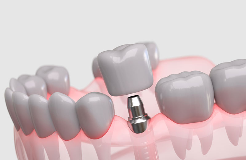 Highly detailed 3D illustration showing a dental implant in place within the jawbone and gum tissue.